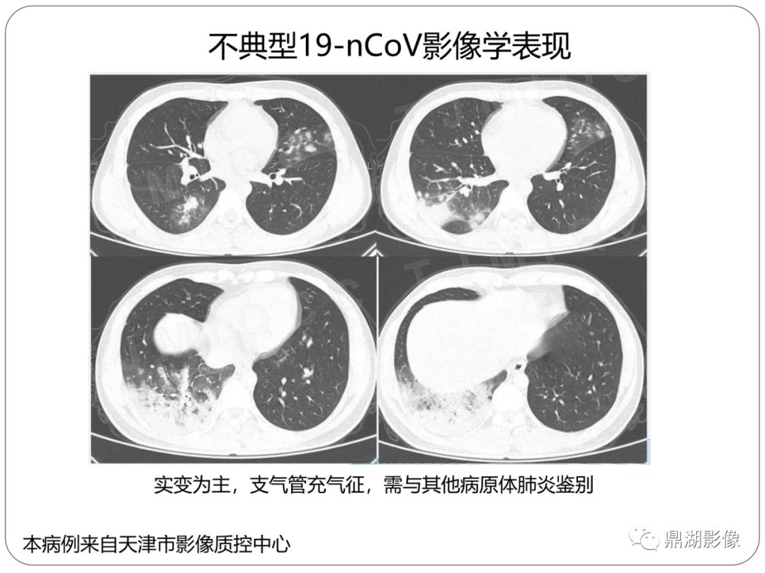 【PPT】新冠状病毒肺炎影像学诊断