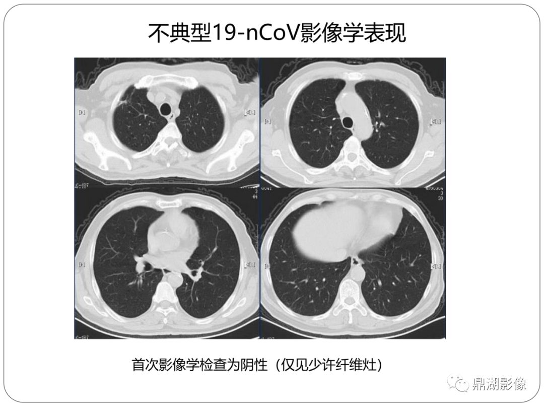 【PPT】新冠状病毒肺炎影像学诊断