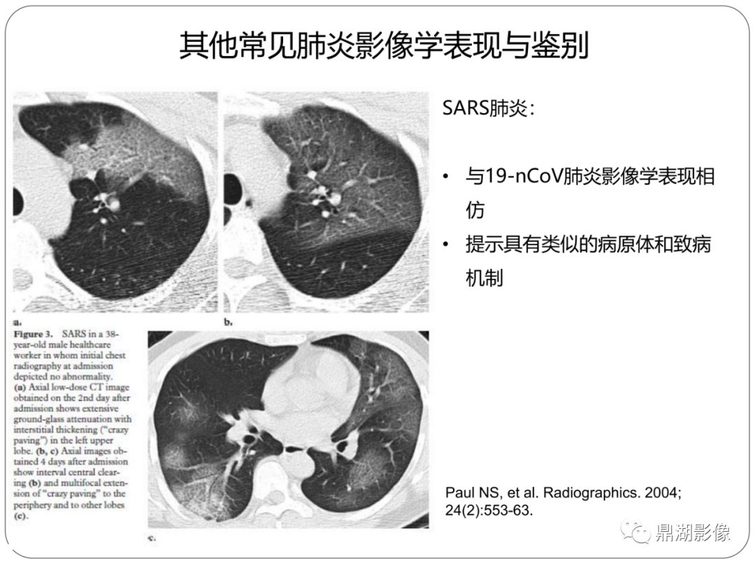 【PPT】新冠状病毒肺炎影像学诊断