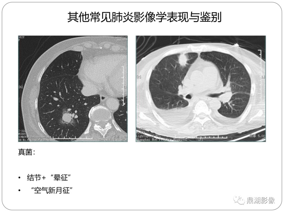 【PPT】新冠状病毒肺炎影像学诊断