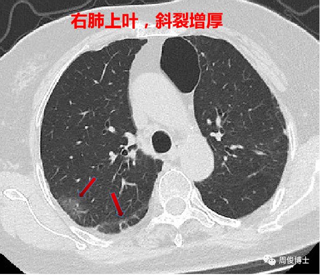 新型冠状病毒肺炎的CT图像 新型冠状病毒肺炎的CT图像