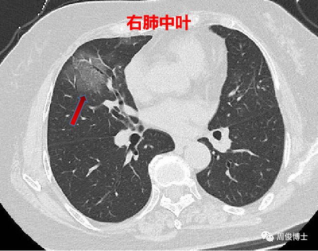 新型冠状病毒肺炎的CT图像 新型冠状病毒肺炎的CT图像