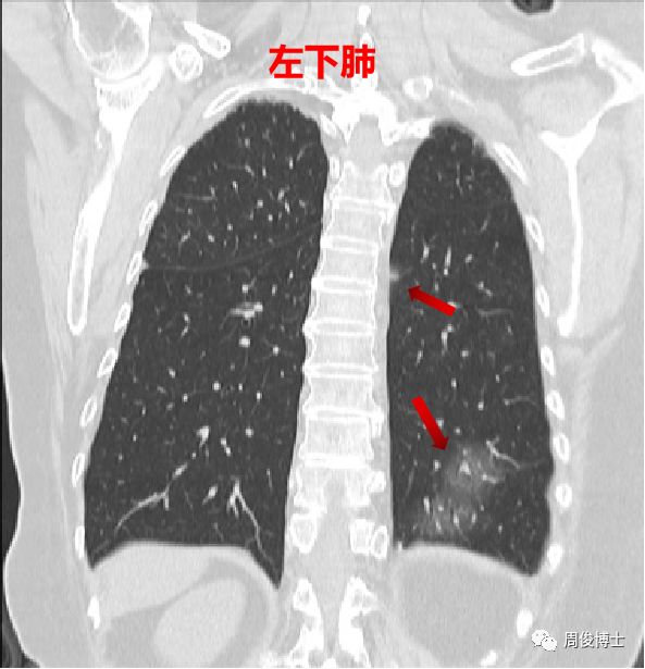 新型冠状病毒肺炎的CT图像 新型冠状病毒肺炎的CT图像