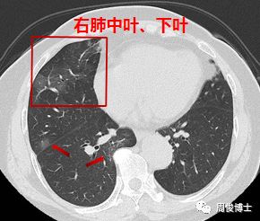 新型冠状病毒肺炎的CT图像