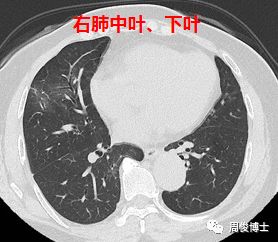 新型冠状病毒肺炎的CT图像 新型冠状病毒肺炎的CT图像