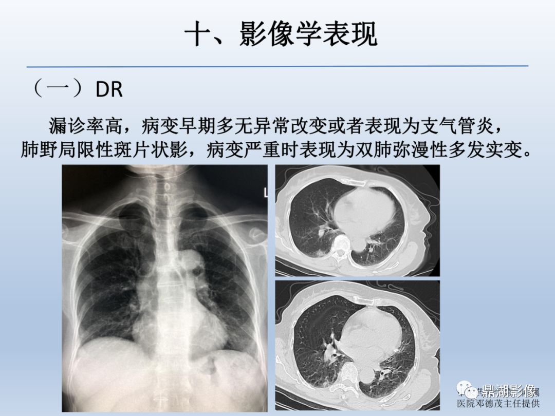 【PPT】新型冠状病毒感染的肺炎影像汇集