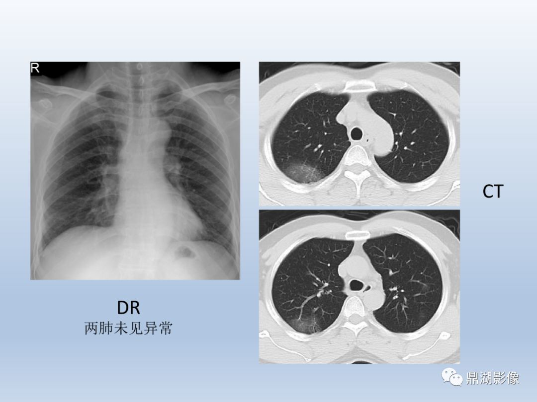 【PPT】新型冠状病毒感染的肺炎影像汇集
