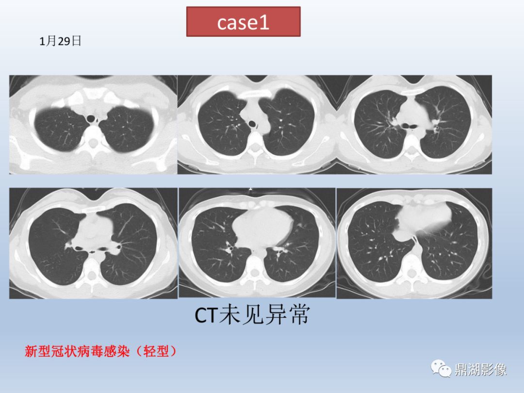 【PPT】新型冠状病毒感染的肺炎影像汇集