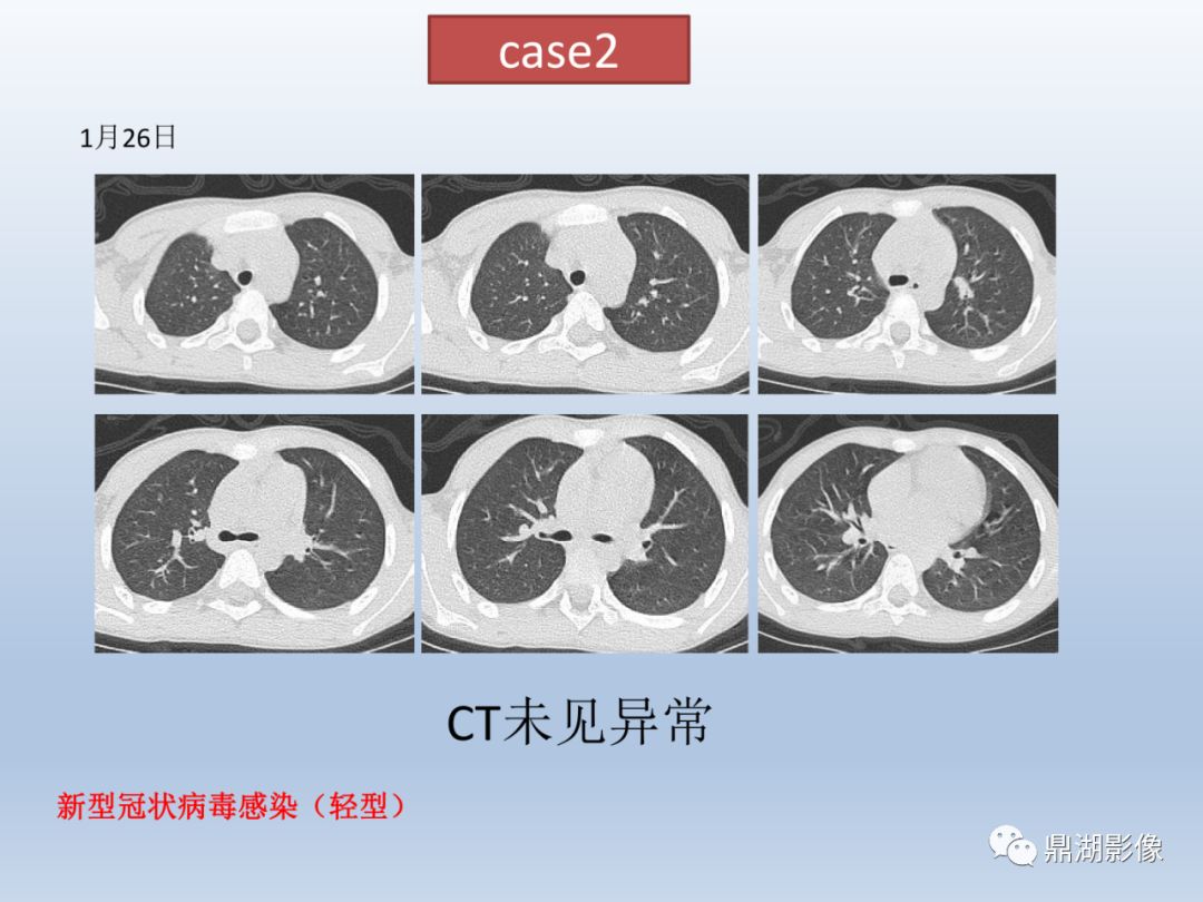【PPT】新型冠状病毒感染的肺炎影像汇集