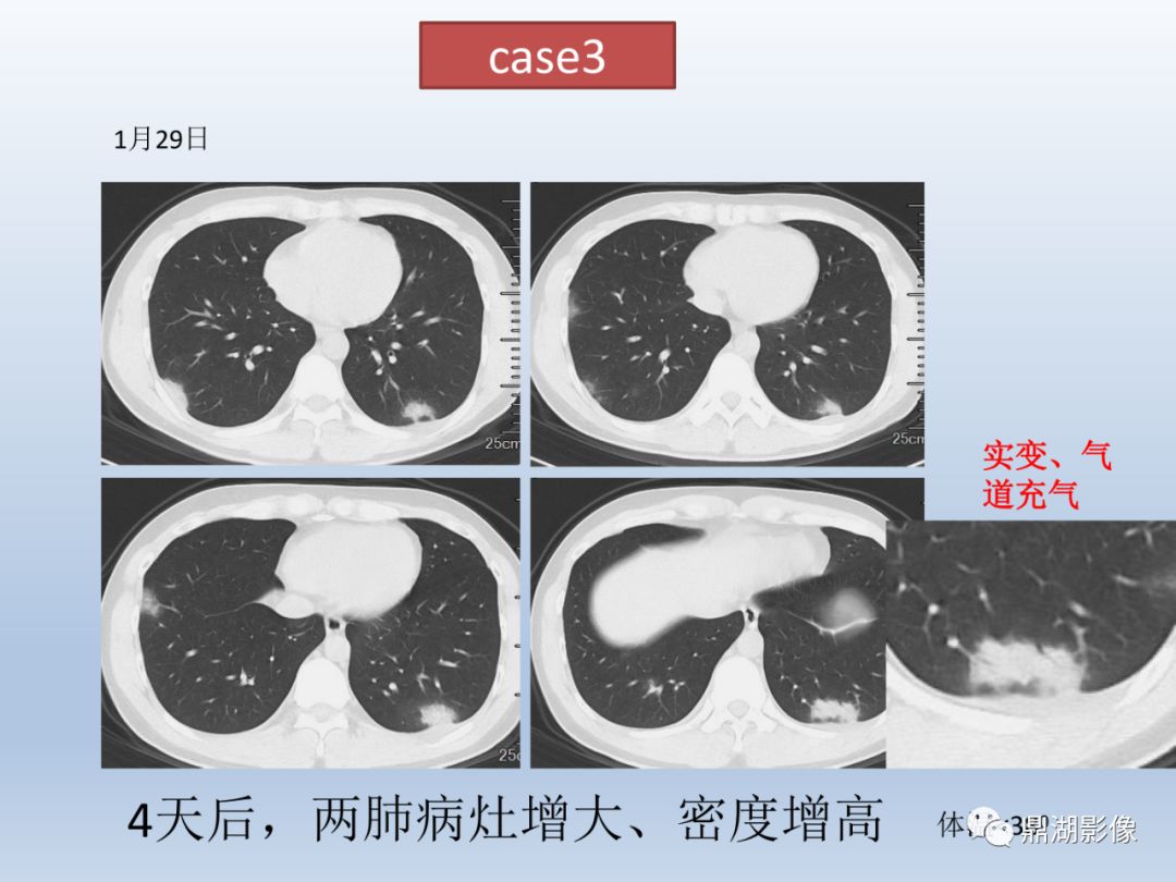 【PPT】新型冠状病毒感染的肺炎影像汇集