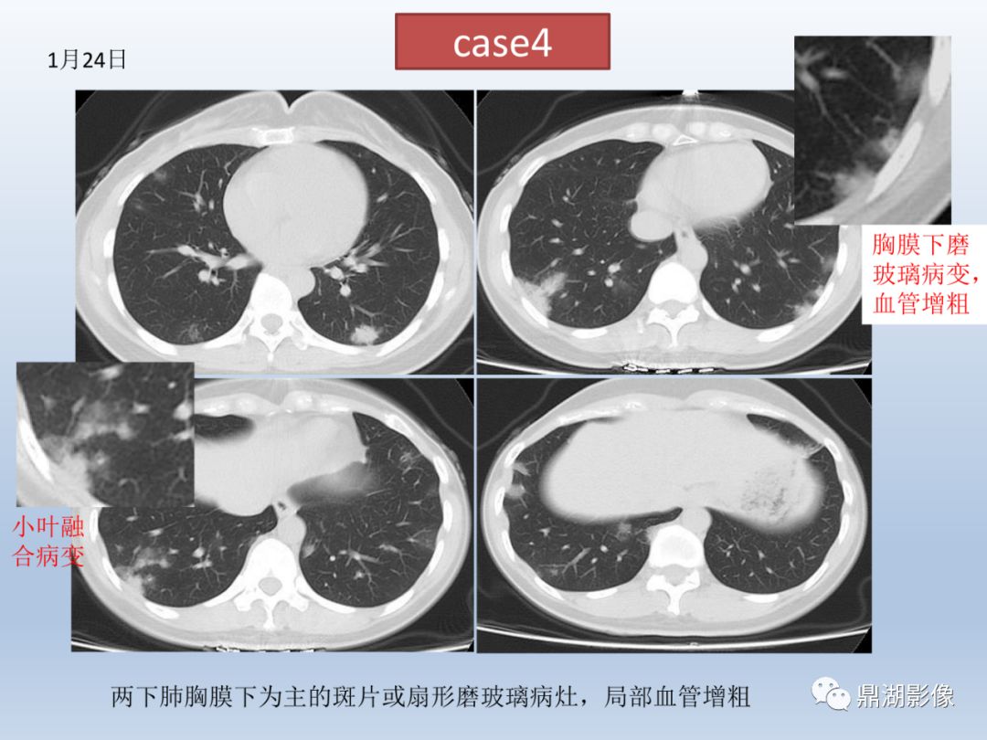 【PPT】新型冠状病毒感染的肺炎影像汇集