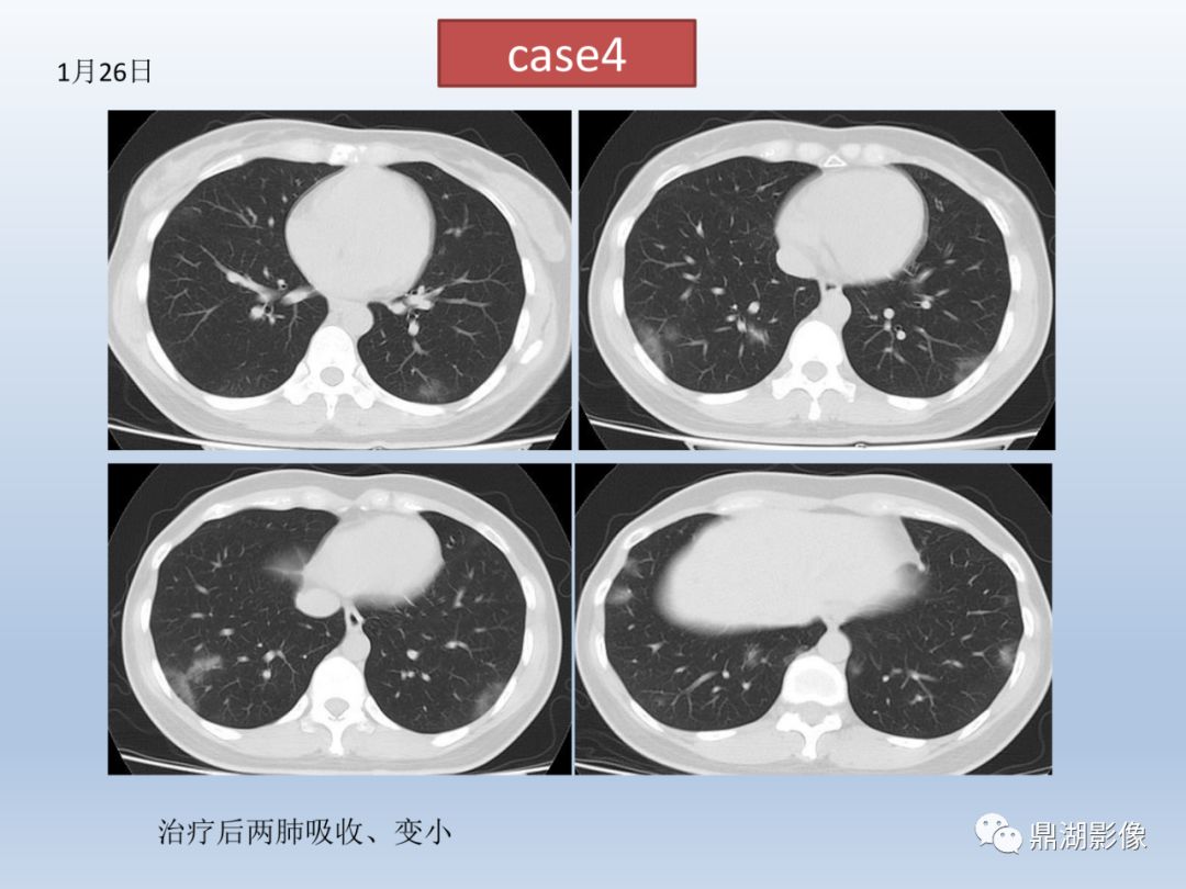 【PPT】新型冠状病毒感染的肺炎影像汇集