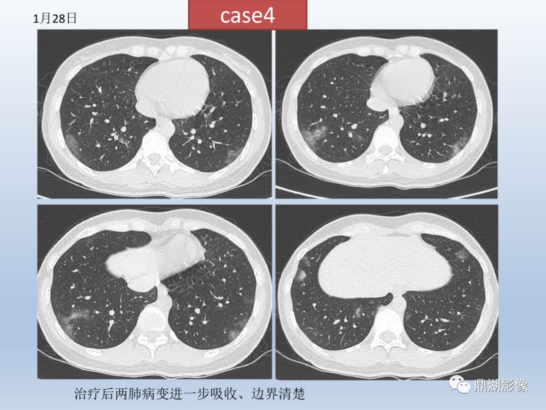 【PPT】新型冠状病毒感染的肺炎影像汇集