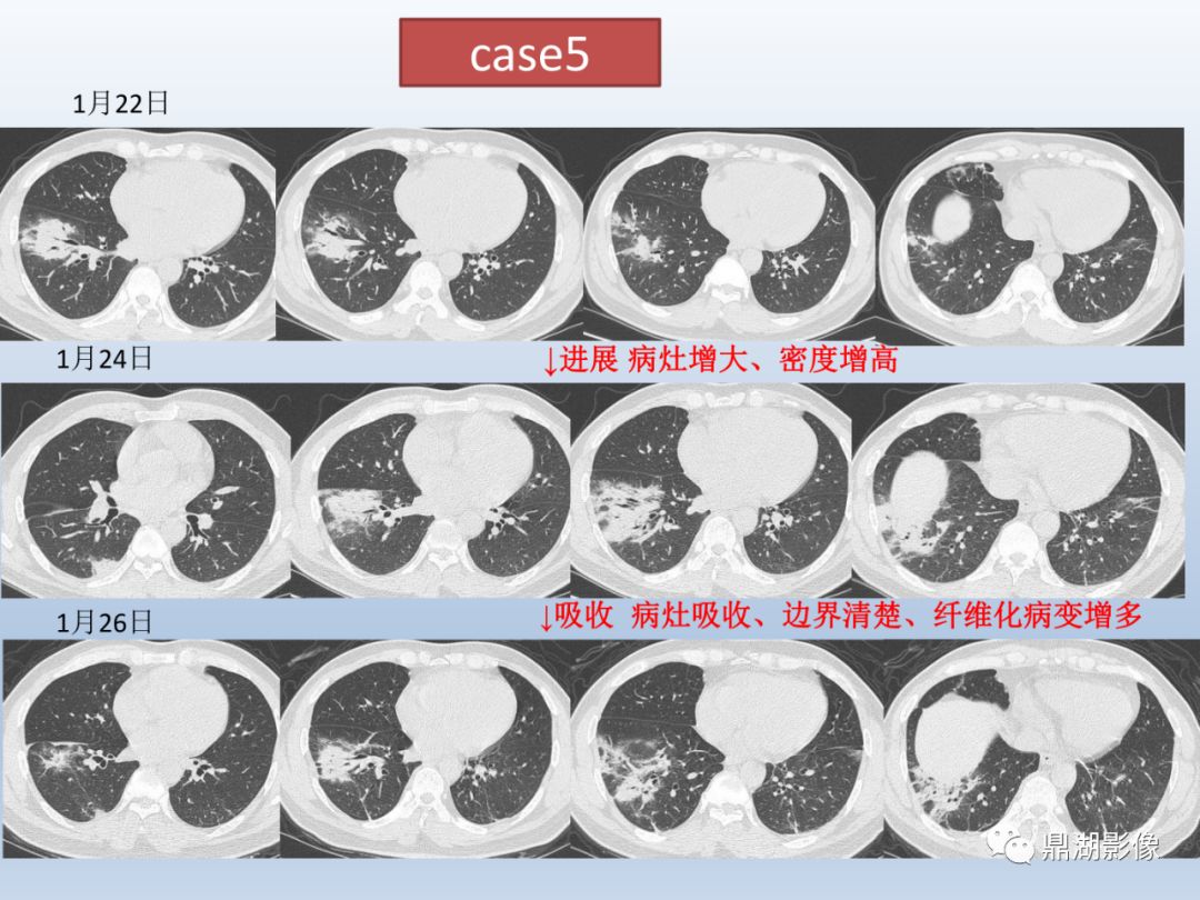 【PPT】新型冠状病毒感染的肺炎影像汇集
