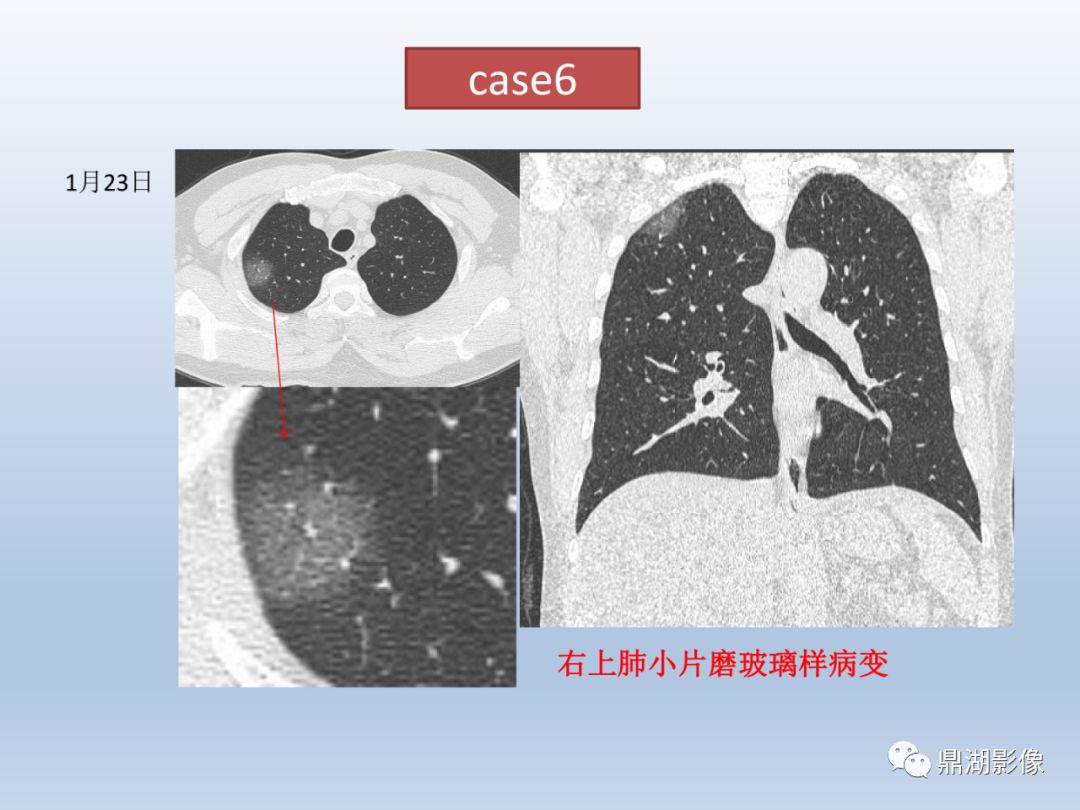【PPT】新型冠状病毒感染的肺炎影像汇集