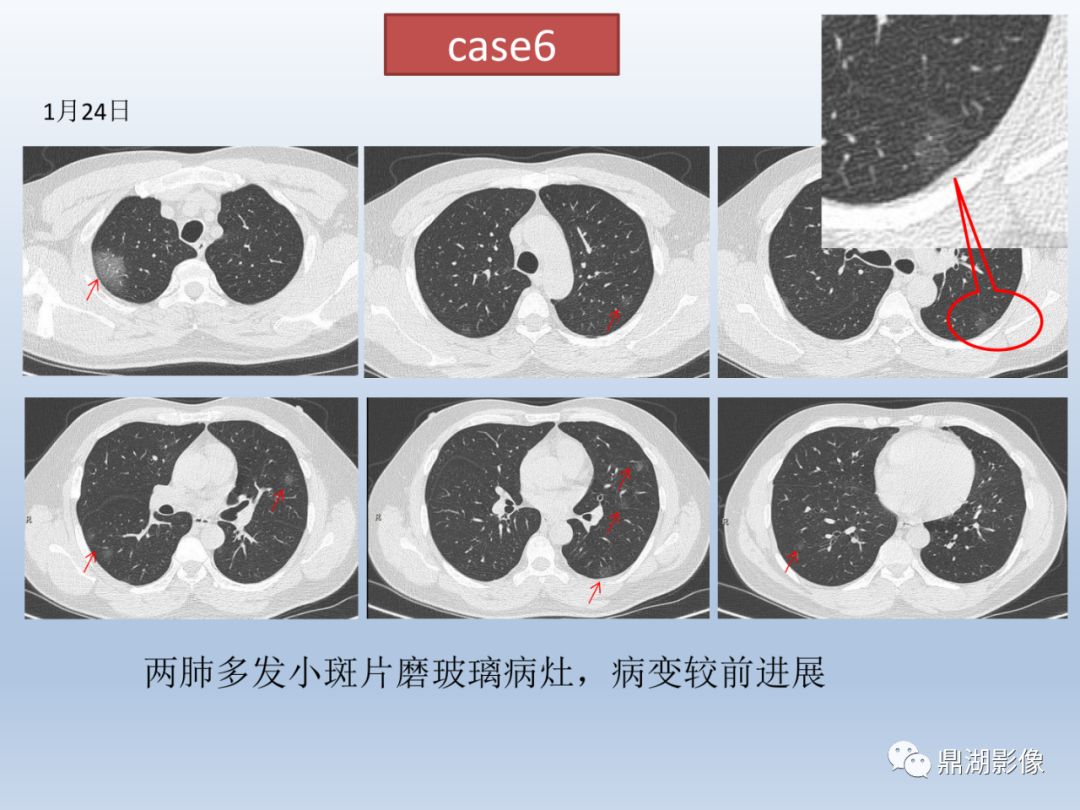 【PPT】新型冠状病毒感染的肺炎影像汇集