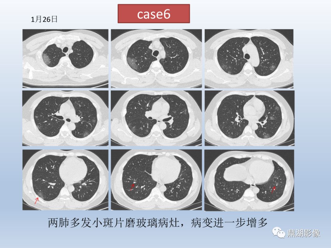 【PPT】新型冠状病毒感染的肺炎影像汇集