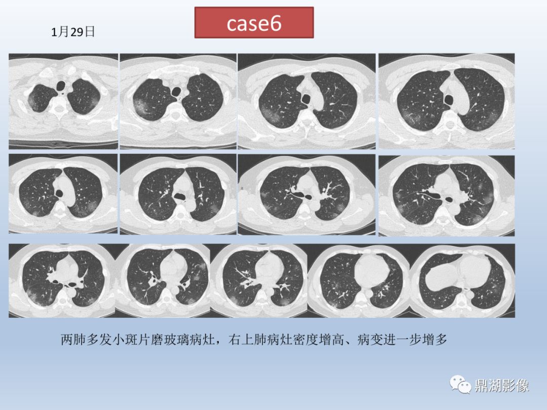 【PPT】新型冠状病毒感染的肺炎影像汇集