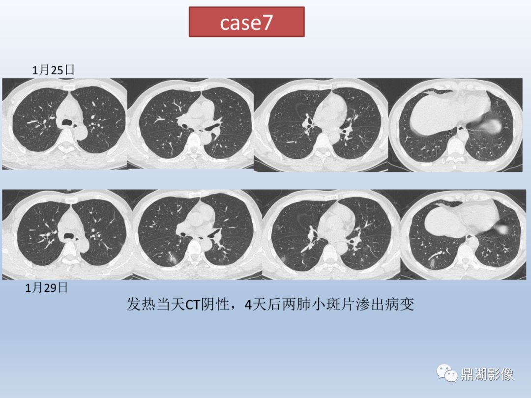 【PPT】新型冠状病毒感染的肺炎影像汇集