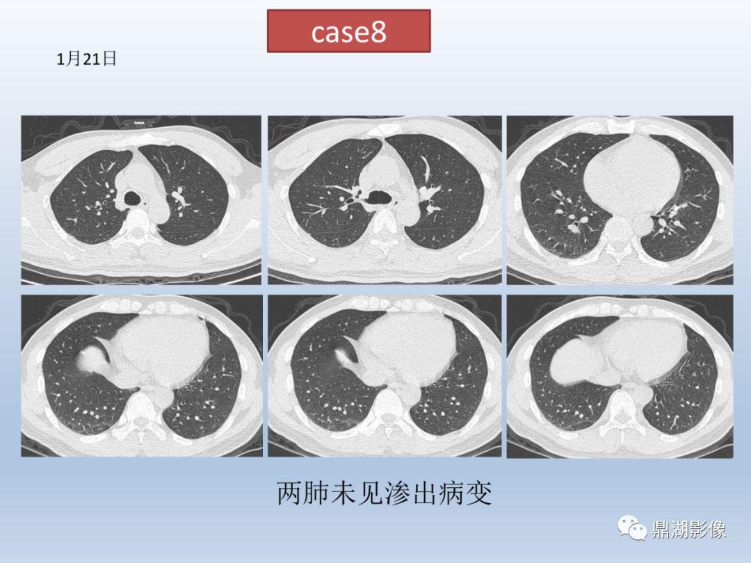 【PPT】新型冠状病毒感染的肺炎影像汇集