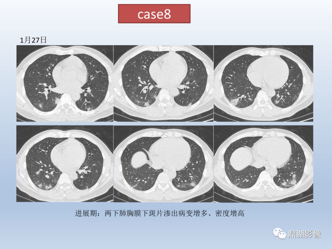 【PPT】新型冠状病毒感染的肺炎影像汇集