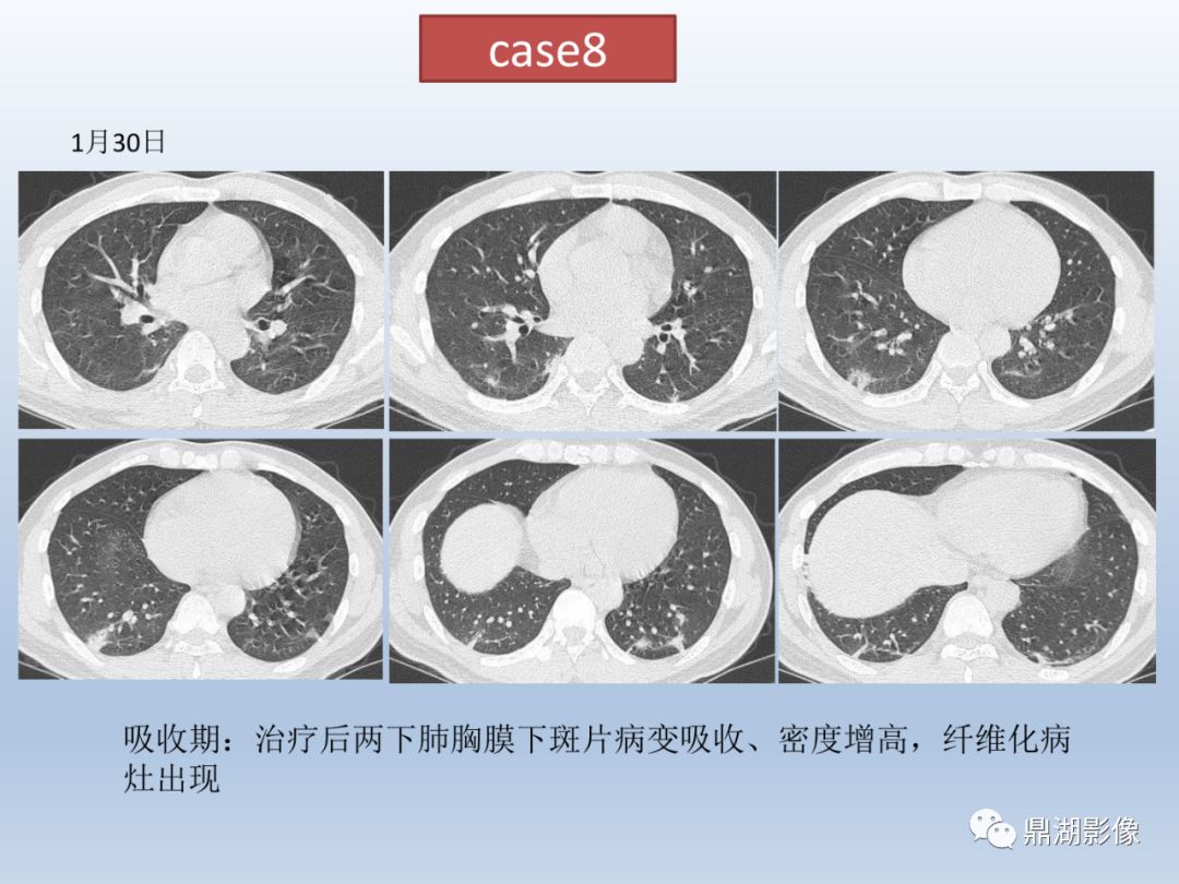 【PPT】新型冠状病毒感染的肺炎影像汇集