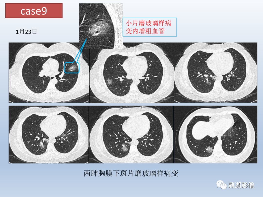 【PPT】新型冠状病毒感染的肺炎影像汇集