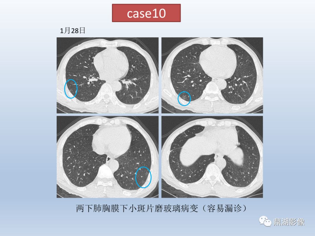 【PPT】新型冠状病毒感染的肺炎影像汇集