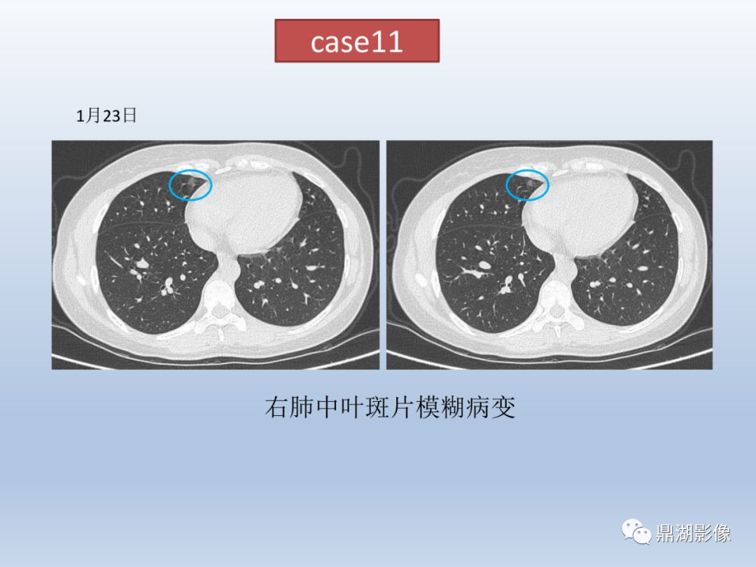 【PPT】新型冠状病毒感染的肺炎影像汇集