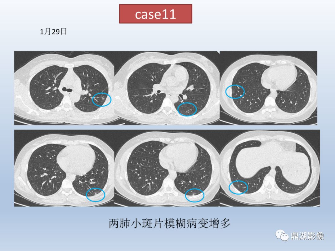 【PPT】新型冠状病毒感染的肺炎影像汇集
