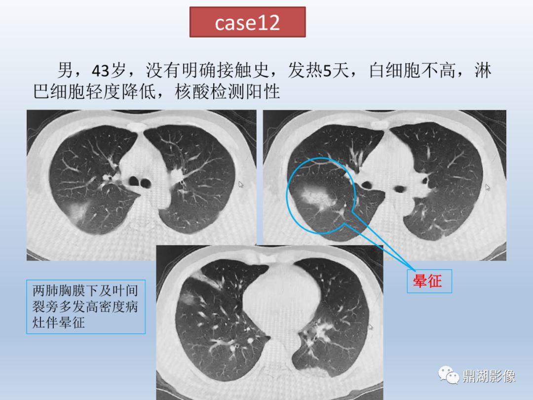 【PPT】新型冠状病毒感染的肺炎影像汇集