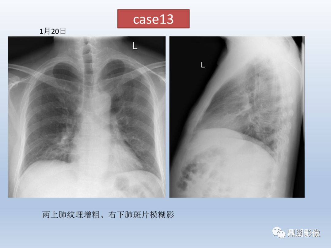 【PPT】新型冠状病毒感染的肺炎影像汇集