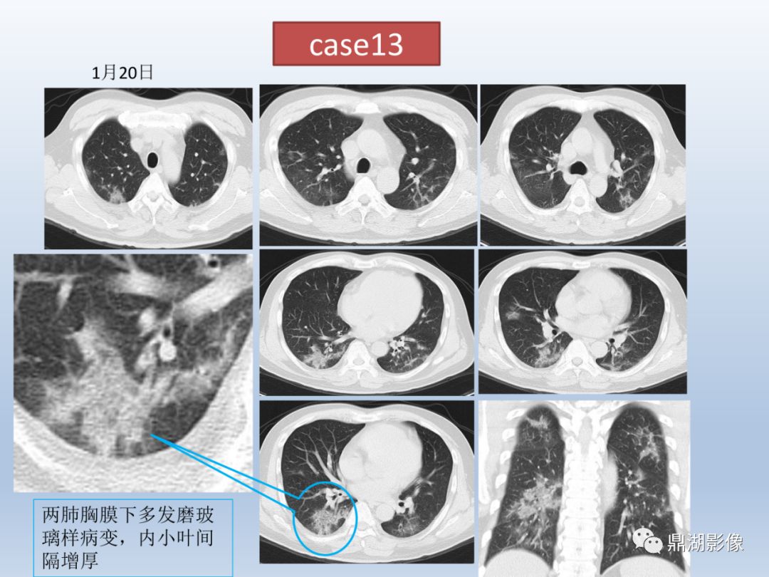 【PPT】新型冠状病毒感染的肺炎影像汇集