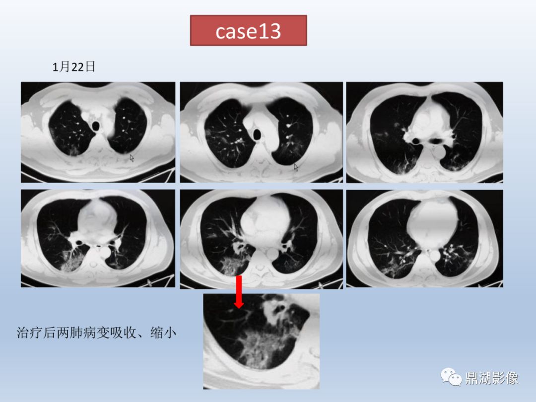 【PPT】新型冠状病毒感染的肺炎影像汇集