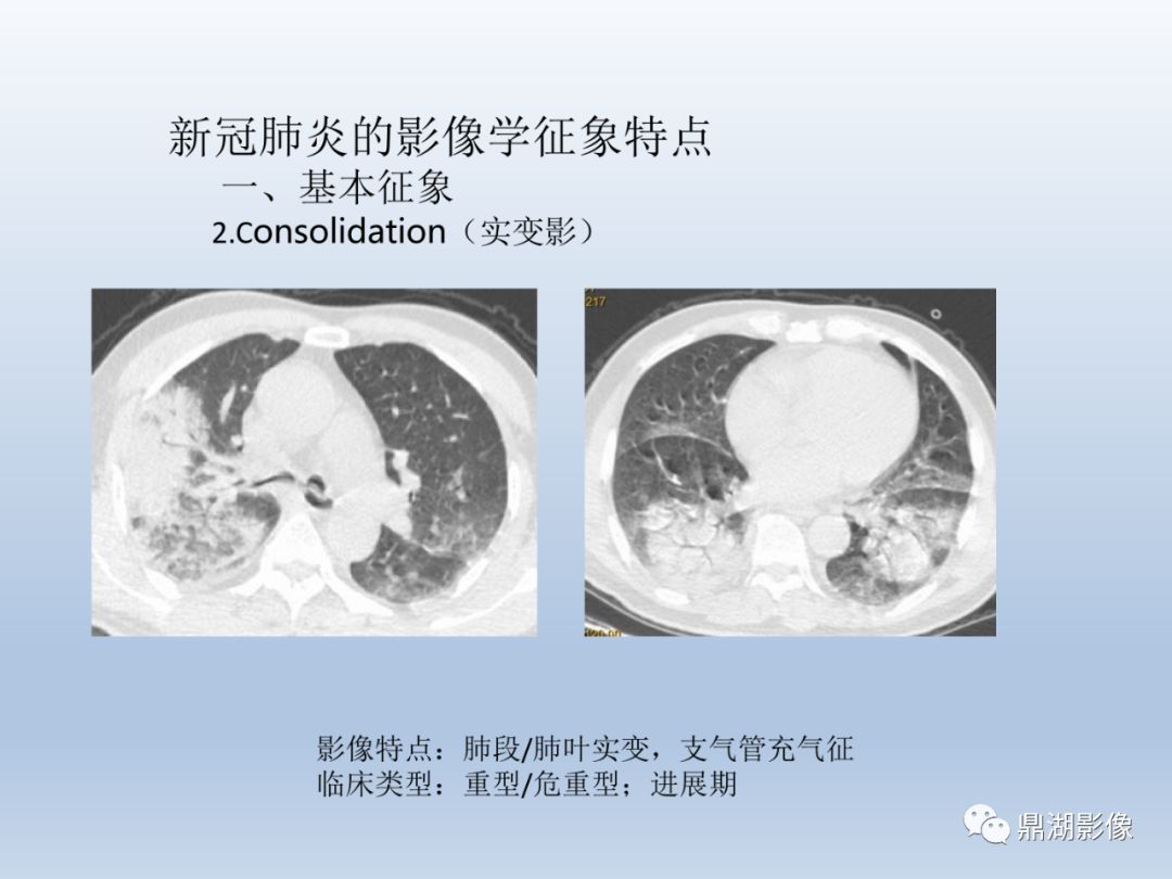 【PPT】新型冠状病毒感染的肺炎影像汇集