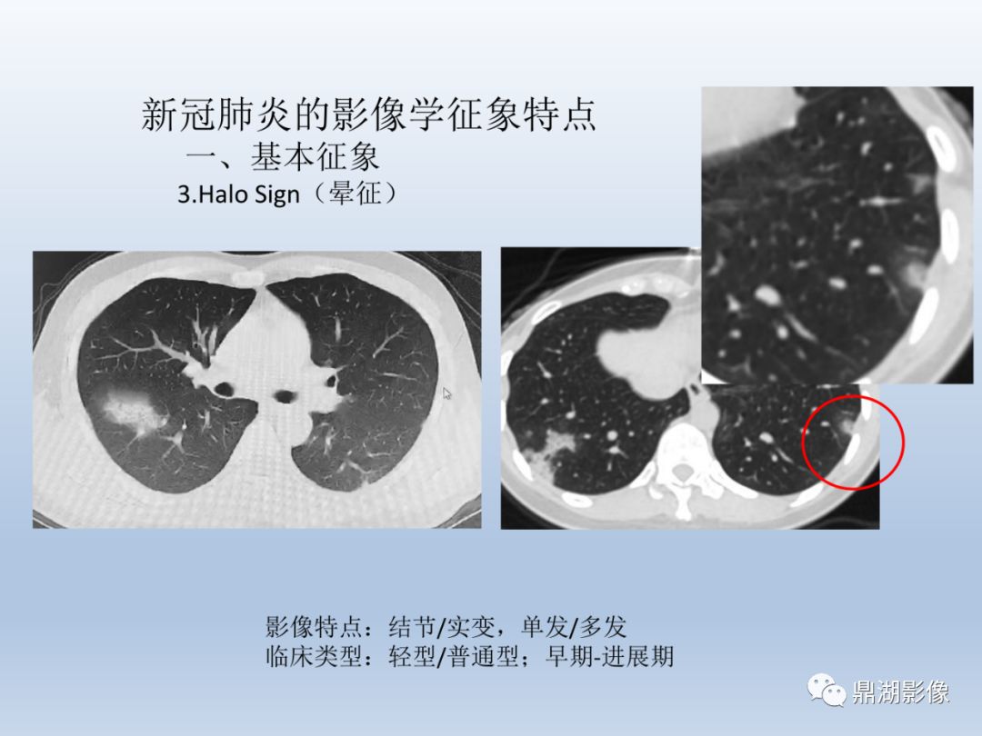 【PPT】新型冠状病毒感染的肺炎影像汇集