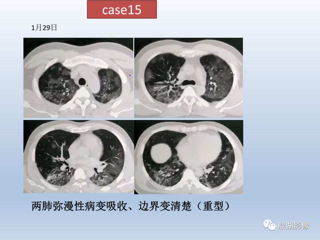 【PPT】新型冠状病毒感染的肺炎影像汇集