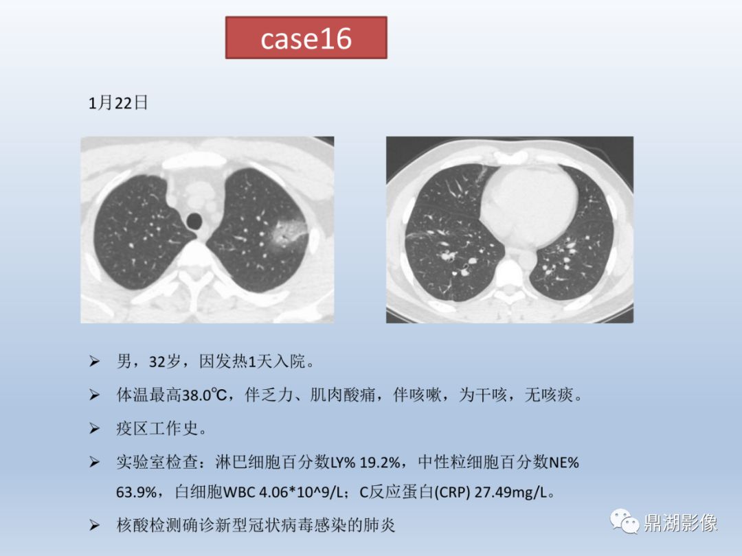 【PPT】新型冠状病毒感染的肺炎影像汇集