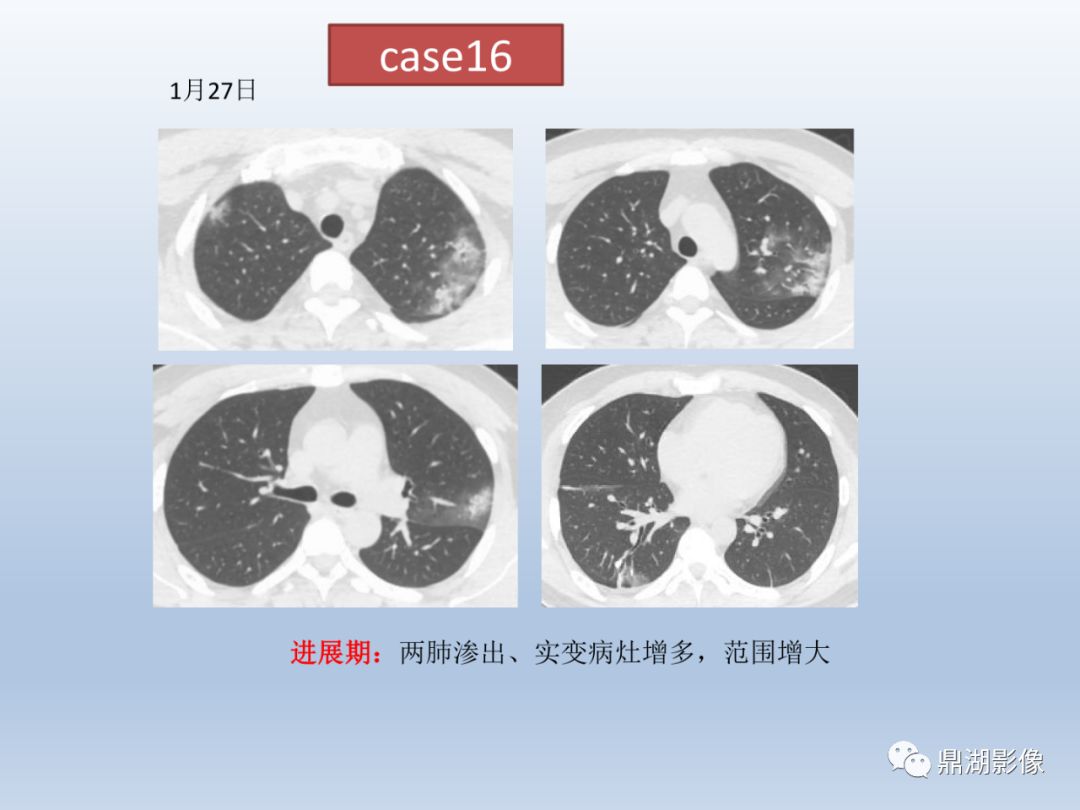 【PPT】新型冠状病毒感染的肺炎影像汇集
