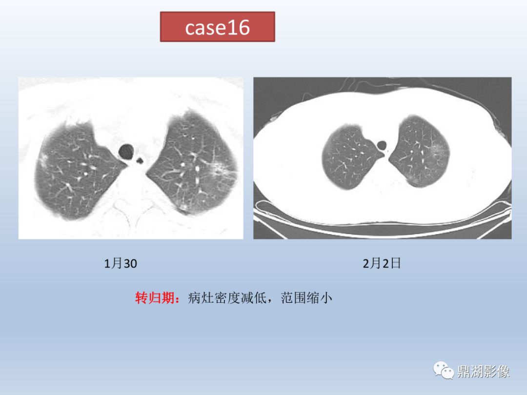 【PPT】新型冠状病毒感染的肺炎影像汇集