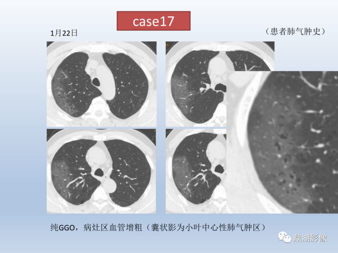 【PPT】新型冠状病毒感染的肺炎影像汇集