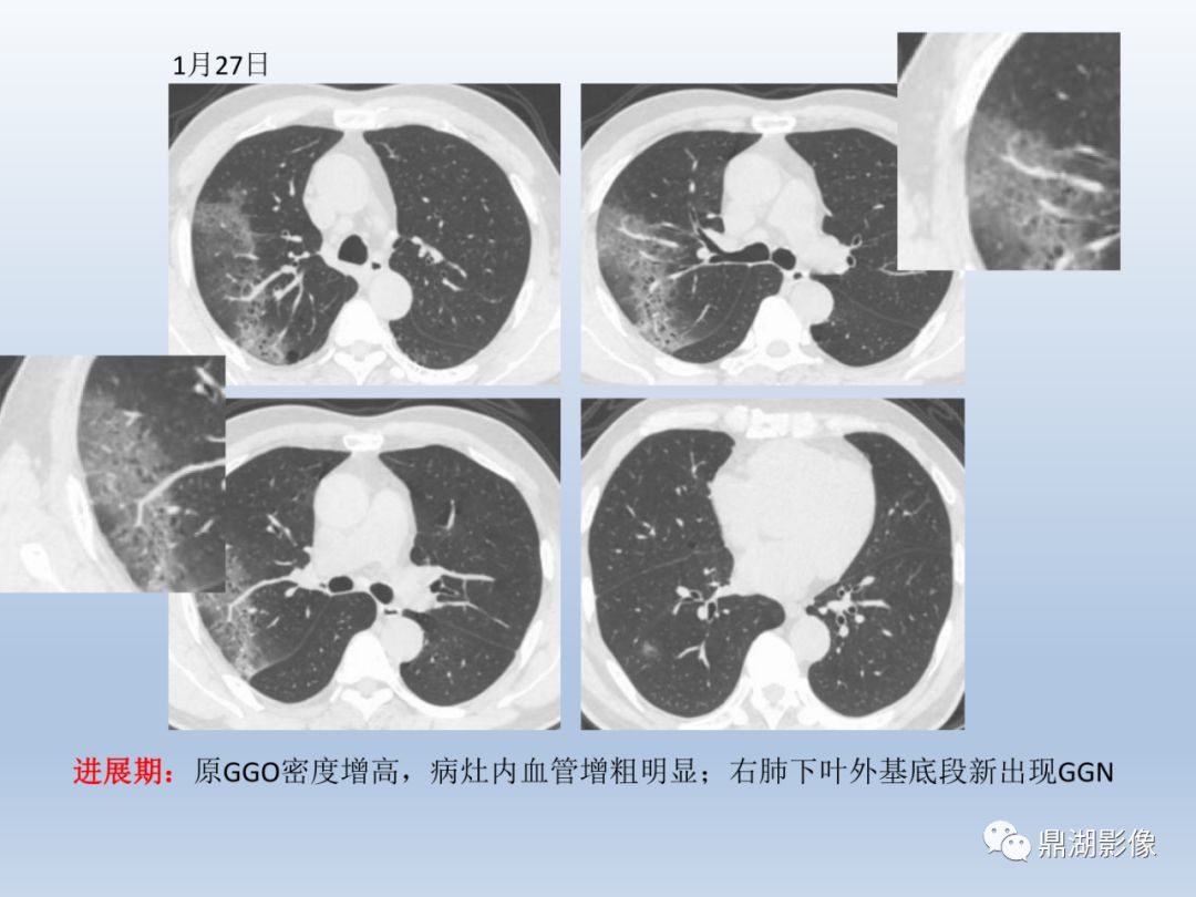 【PPT】新型冠状病毒感染的肺炎影像汇集