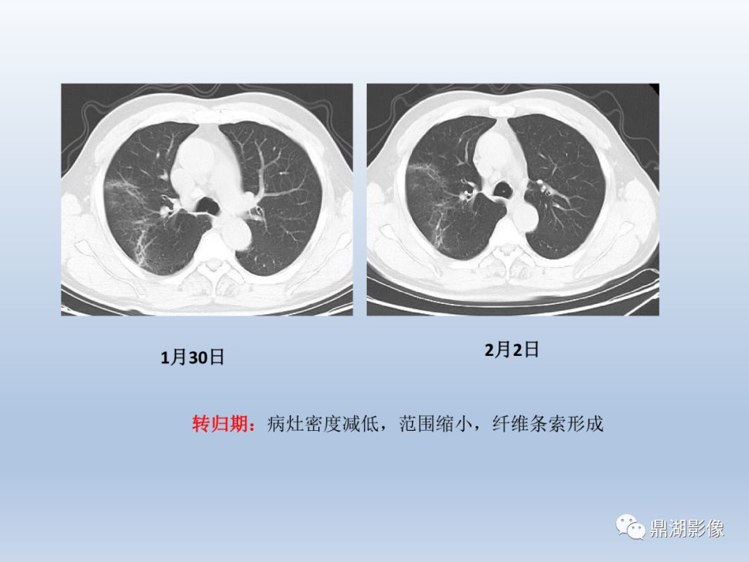 【PPT】新型冠状病毒感染的肺炎影像汇集