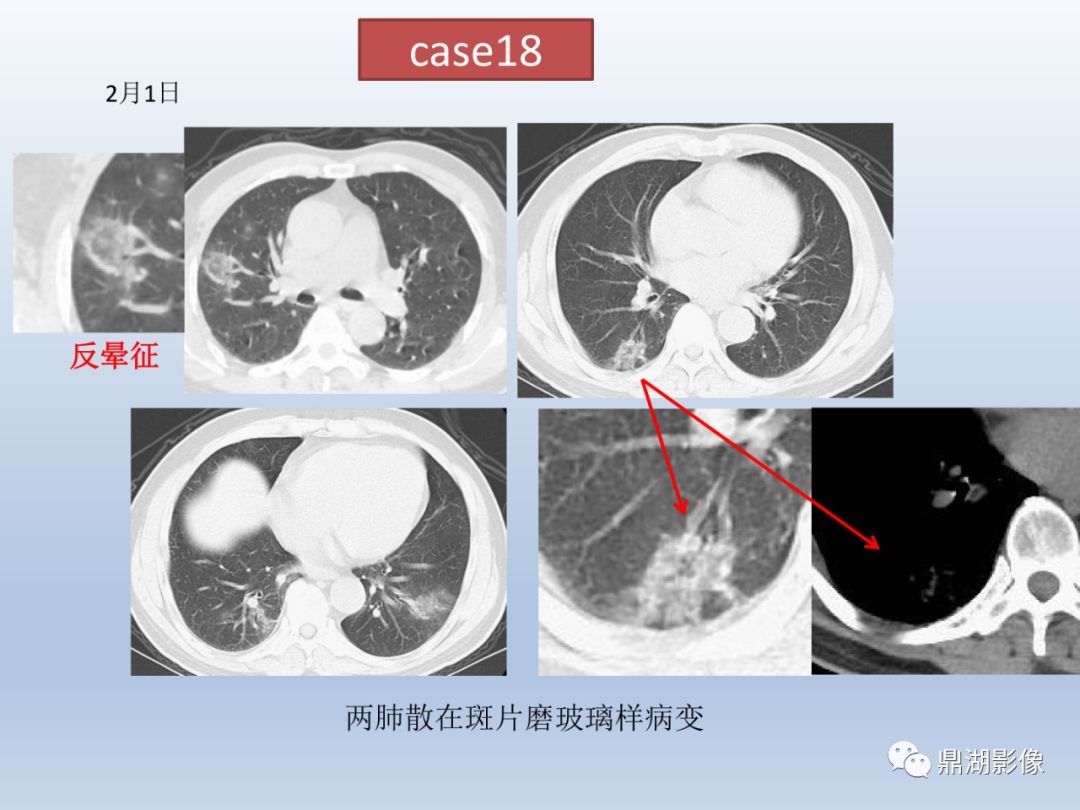 【PPT】新型冠状病毒感染的肺炎影像汇集