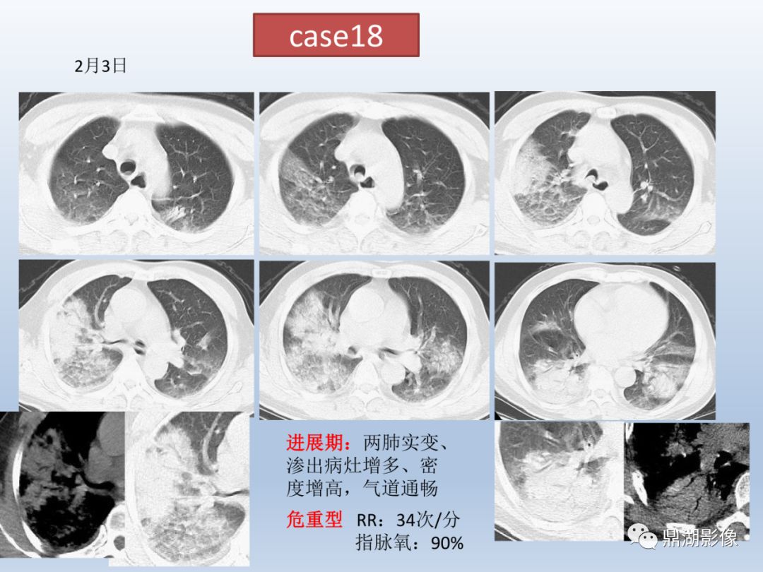 【PPT】新型冠状病毒感染的肺炎影像汇集