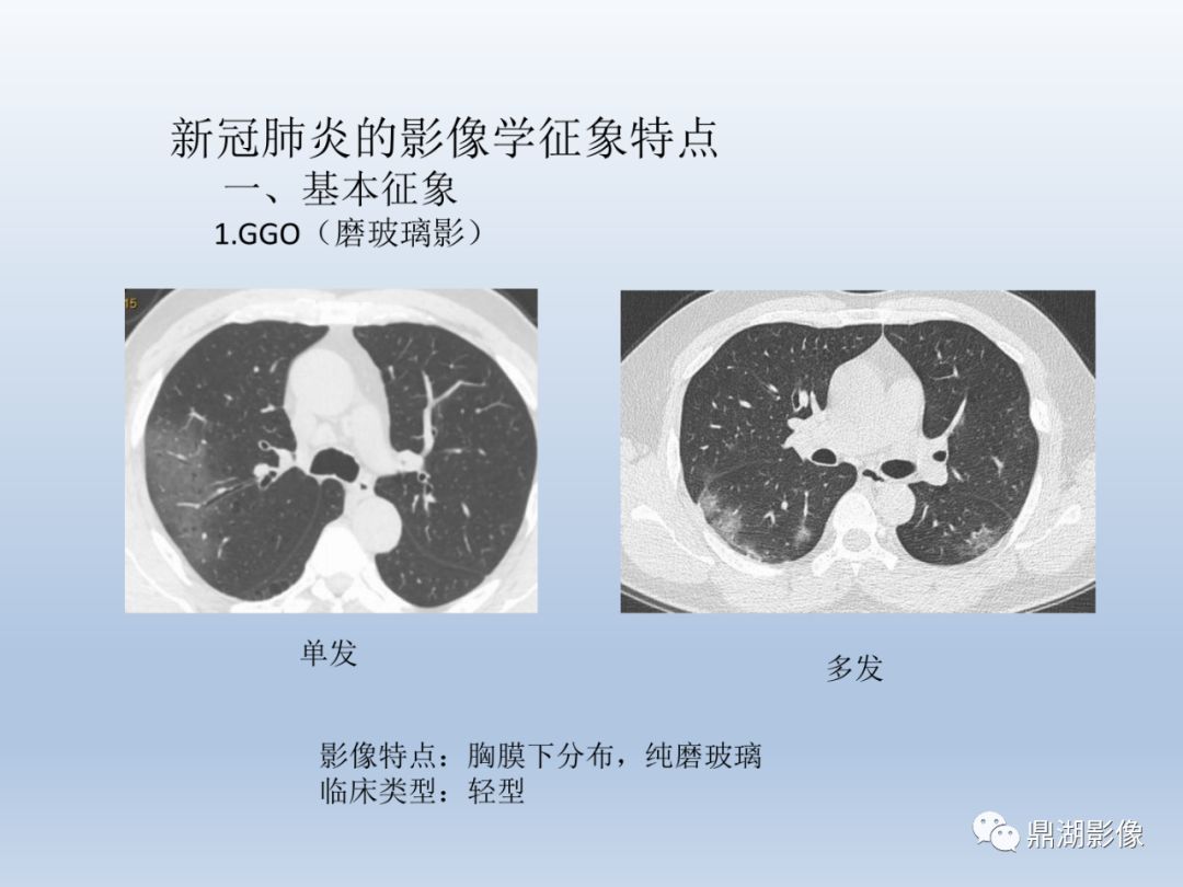 【PPT】新型冠状病毒感染的肺炎影像汇集