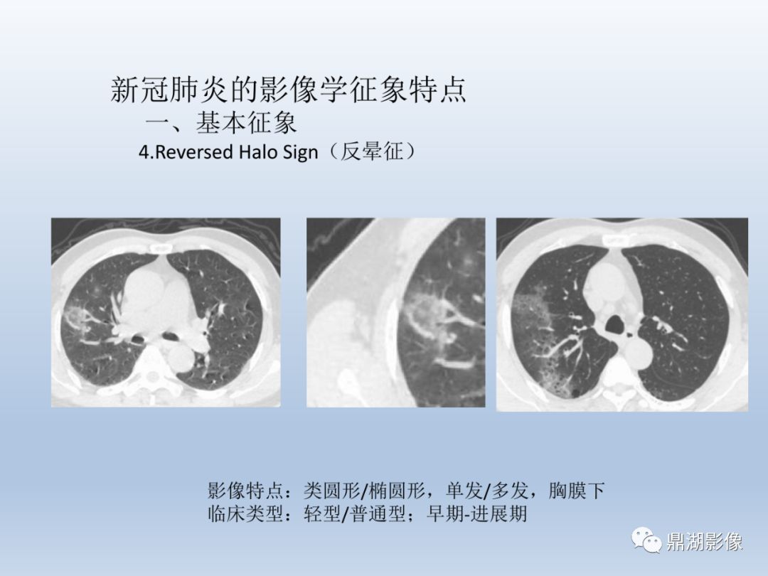 【PPT】新型冠状病毒感染的肺炎影像汇集