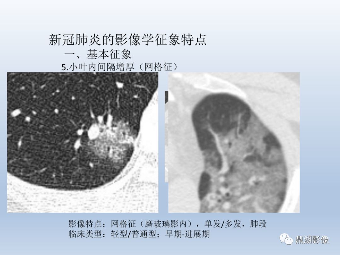 【PPT】新型冠状病毒感染的肺炎影像汇集