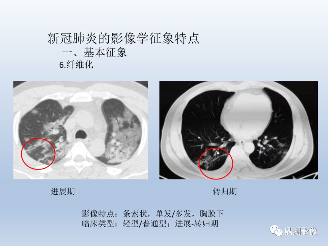 【PPT】新型冠状病毒感染的肺炎影像汇集