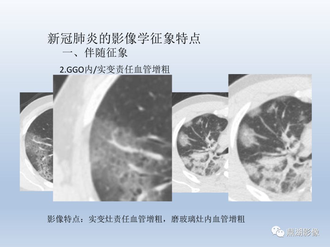 【PPT】新型冠状病毒感染的肺炎影像汇集